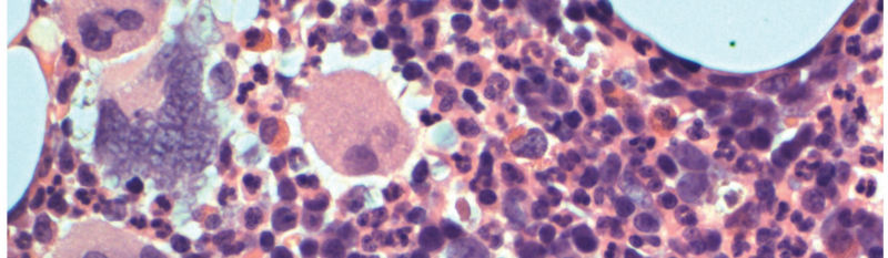 Bone marrow biopsy / Wellcome Sanger Institute