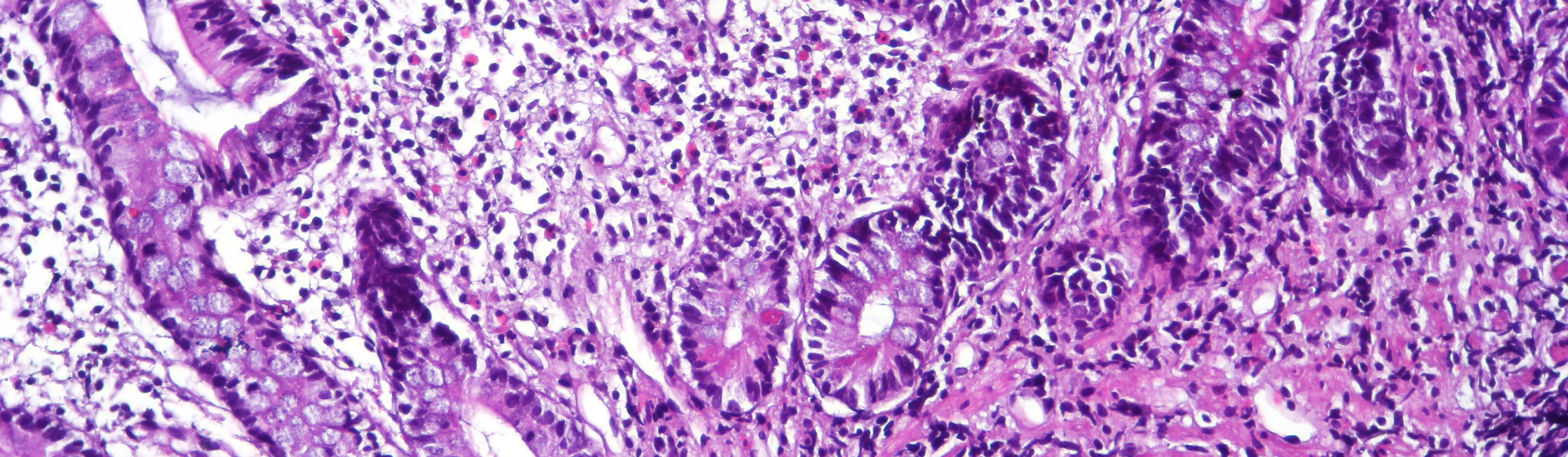 Ileum biopsy from Crohn's patient / WikiMedia Commons (CoRus13)