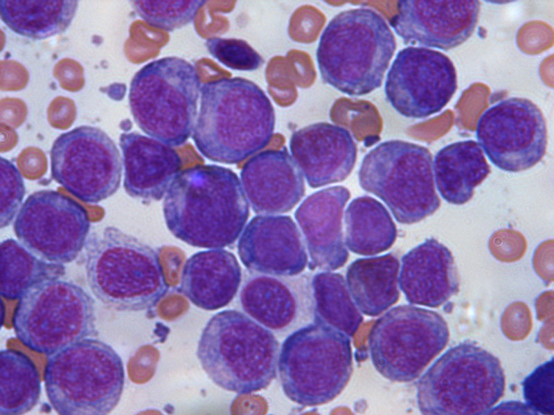case study on acute myeloid leukaemia